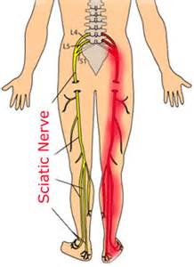 Where the sciatica nerve runs and origins of pain come from