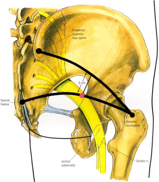 Main area the sciatica nerve pinches