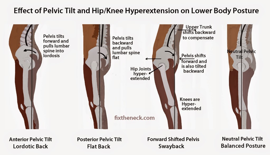 Front pelvic tilt always leads to weak glutes.